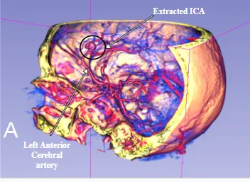 Internal carotid artery geometry from the CT scan
